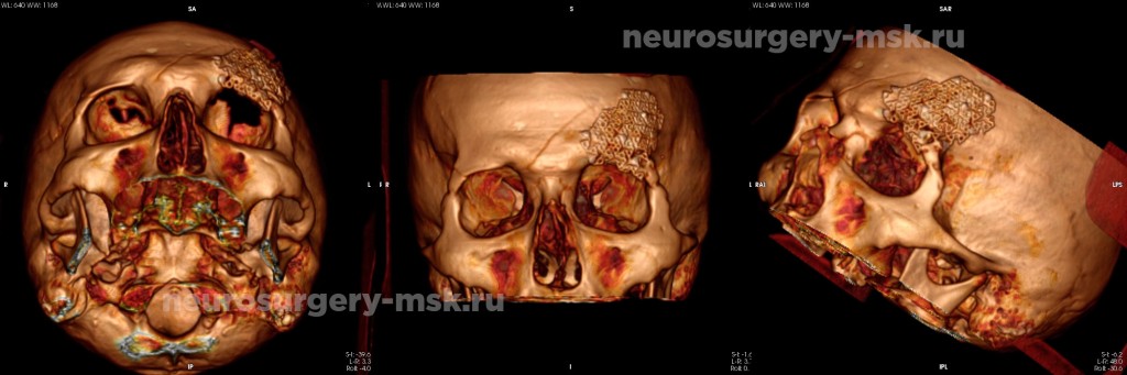 Репозиция вдавленного перелома свода черепа после операции