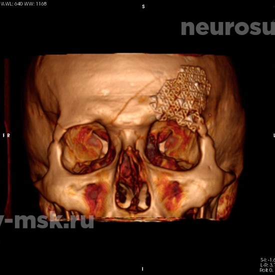 Репозиция вдавленного перелома свода черепа после операции