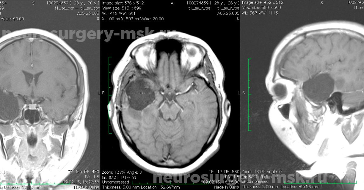 Астроцитома головного мозга прогноз. Менингиома клиновидной кости. Резекция правой височной доли. Астроцитома доброкачественная или злокачественная. Глиальная опухоль височной доли.