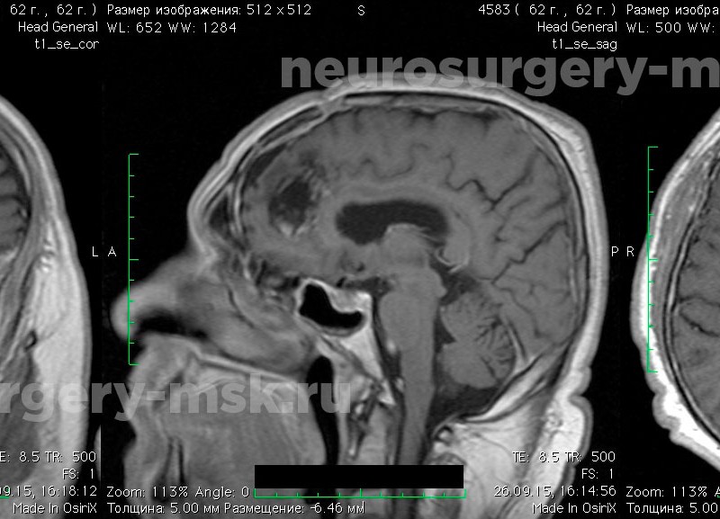 После операции менингиомы головного мозга. Менингиома головного мозга кт. Фалькс менингиома головного. Фалькс менингиома кт.