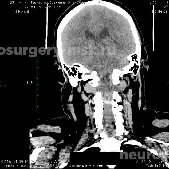 Udalenie meningiomy kranio vertebralnogo perehoda 2 550x550 - Удаление менингиомы кранио-вертебрального перехода