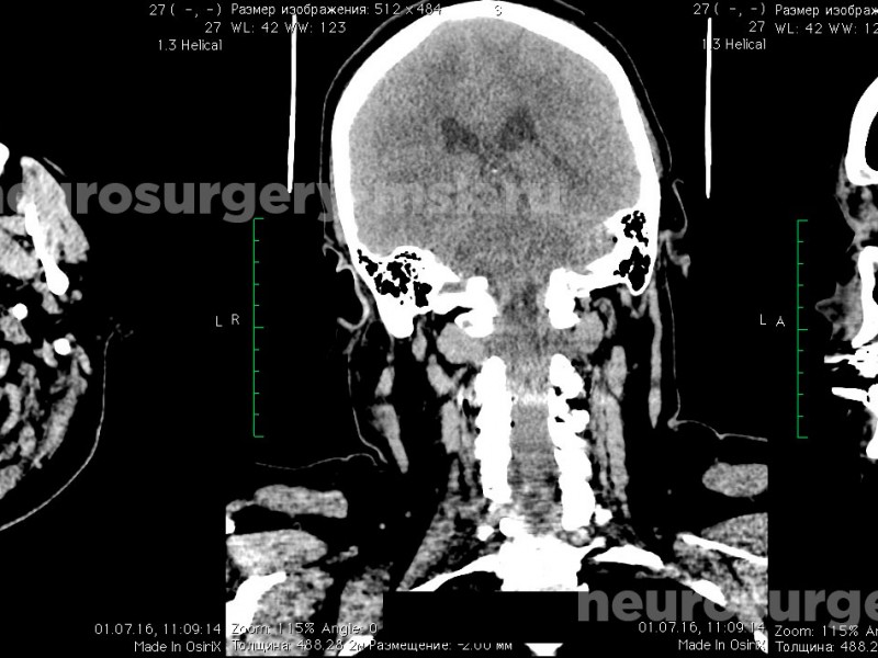 Udalenie meningiomy kranio vertebralnogo perehoda 2 800x600 - Удаление менингиомы кранио-вертебрального перехода