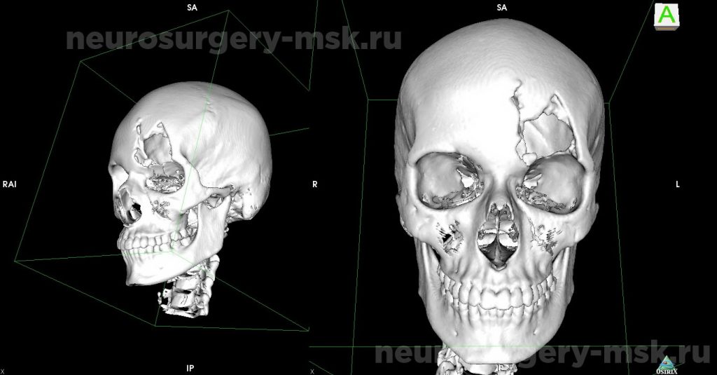 Дефект костей свода черепа в левой лобно-орбитальной области до операции
