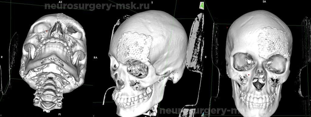 Дефект костей свода черепа в левой лобно-орбитальной области после операции