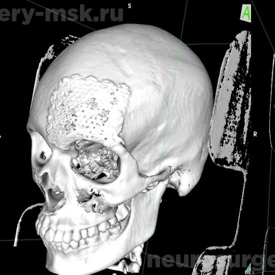 Дефект костей свода черепа в левой лобно-орбитальной области после операции