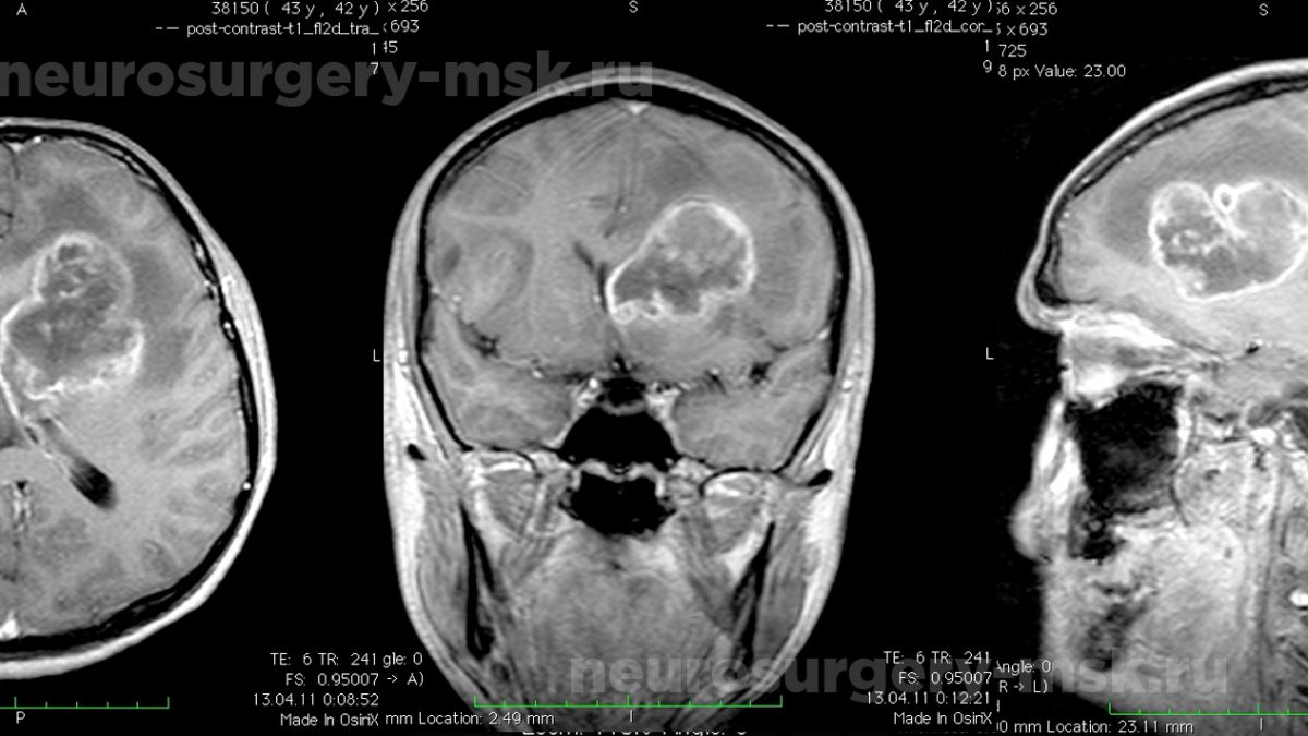 Лечение глиобластомы головного мозга в Москве, диагностика, симптомы,  операция по удалению глиобластомы, эндоскопически