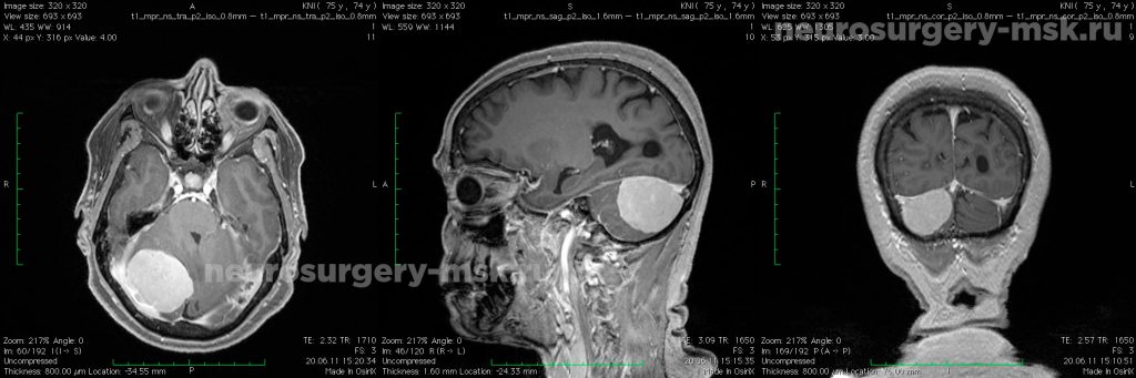 Менингиома мозжечкового намета (до операции)