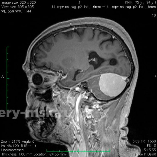 Менингиома мозжечкового намета (до операции)