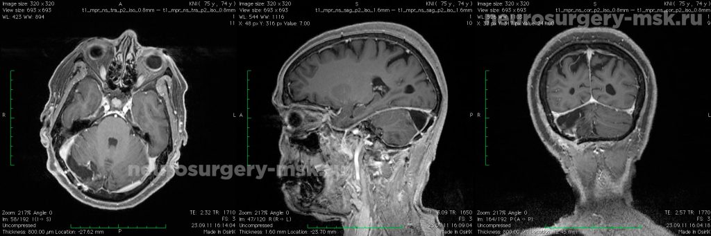 Менингиома мозжечкового намета (после операции)