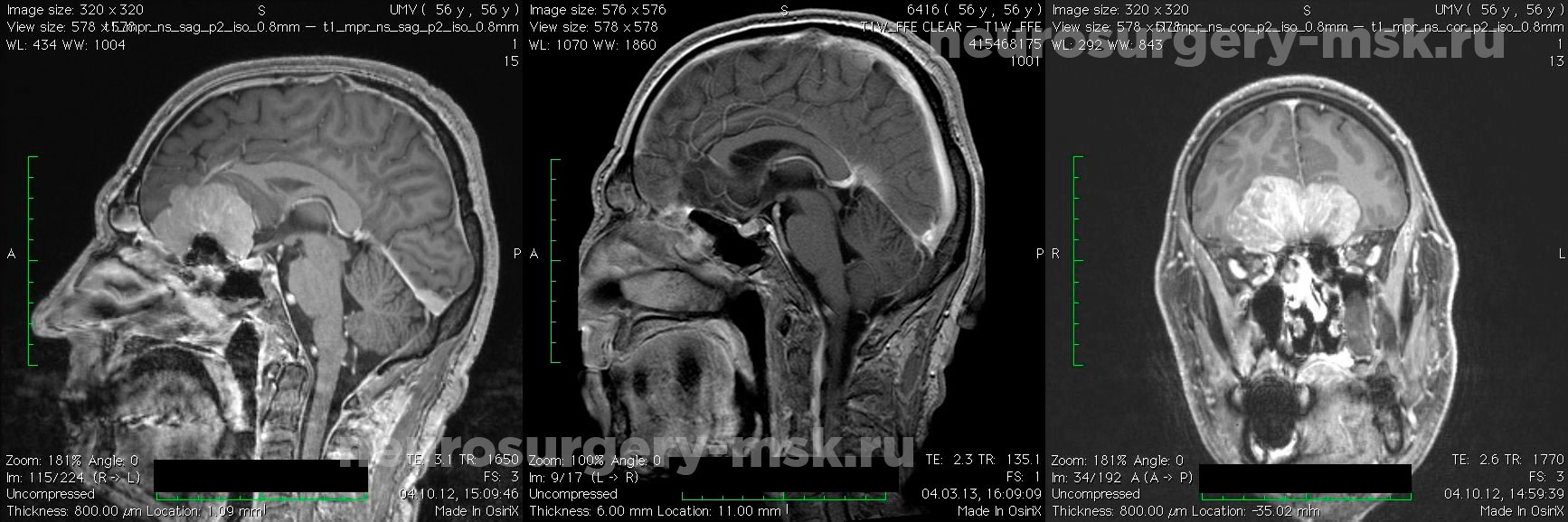 После операции менингиомы головного мозга. Опухоль головного мозга ольфакторной ямки. Менингиомы кавернозного синуса. Менингиома ольфакторной ямки кт. Менингиома головного мозга кт.