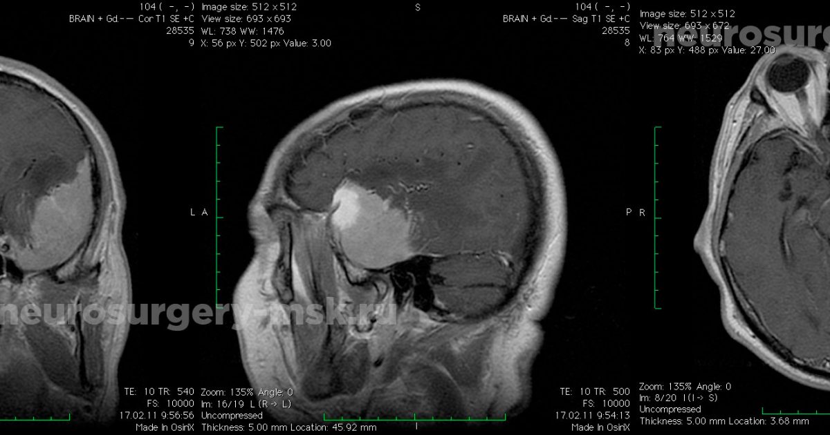 После операции менингиомы головного мозга