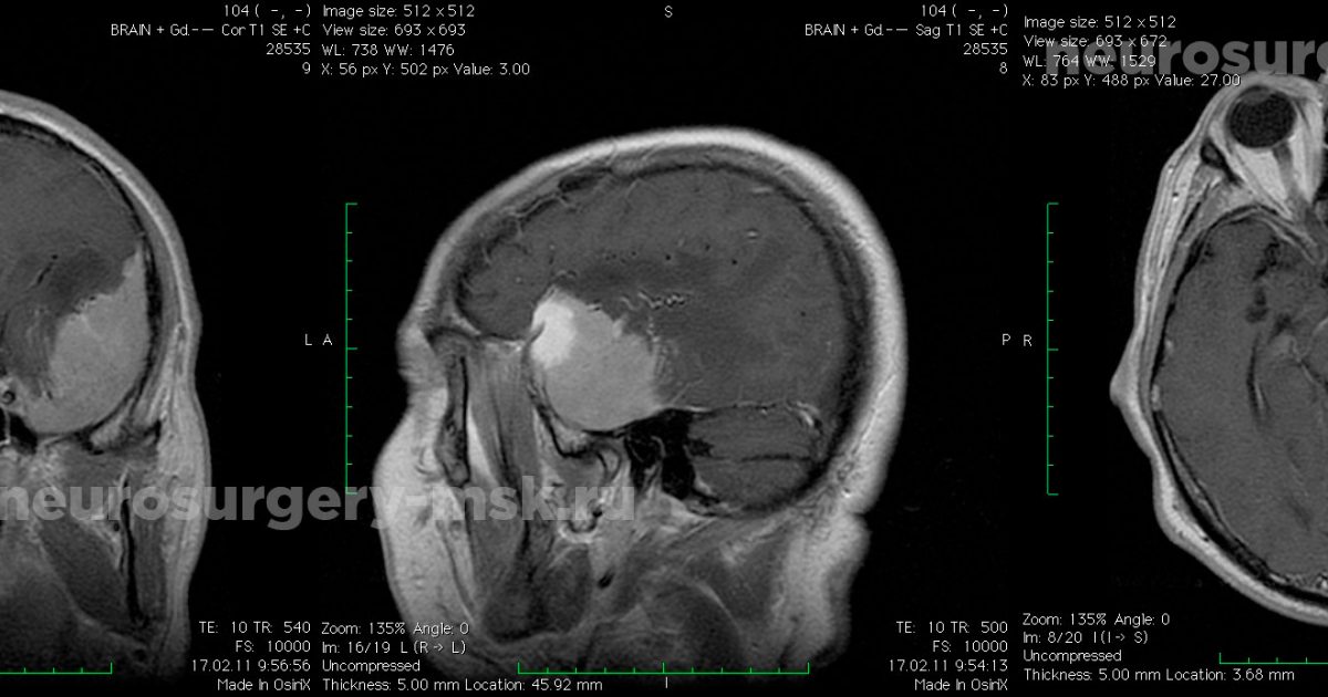 Менингиома головного мозга продолжительность операции. Менингиома серповидного отростка. Менингиома височной доли. Менингиома теменной области.
