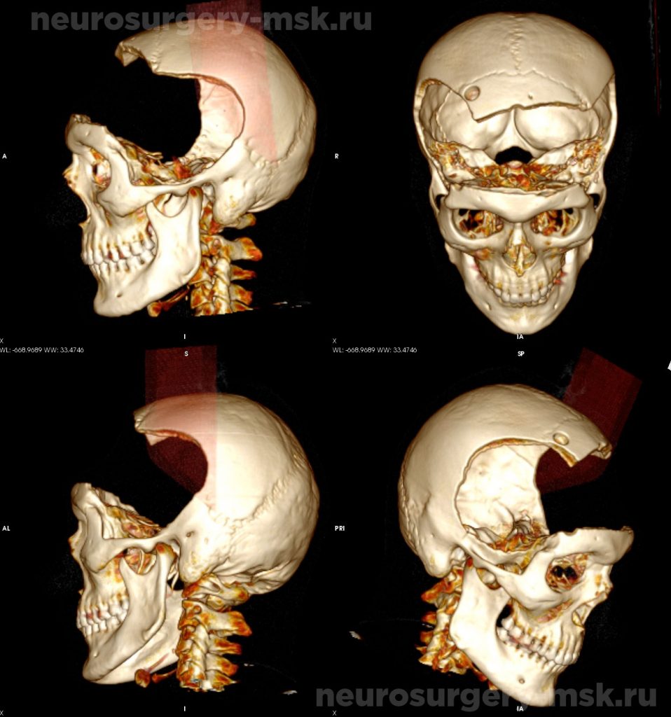 Обширный дефект костей свода черепа до операции