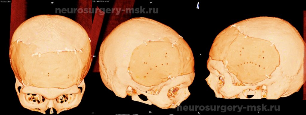 Обширный дефект костей свода черепа после операции