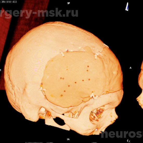 Обширный дефект костей свода черепа после операции