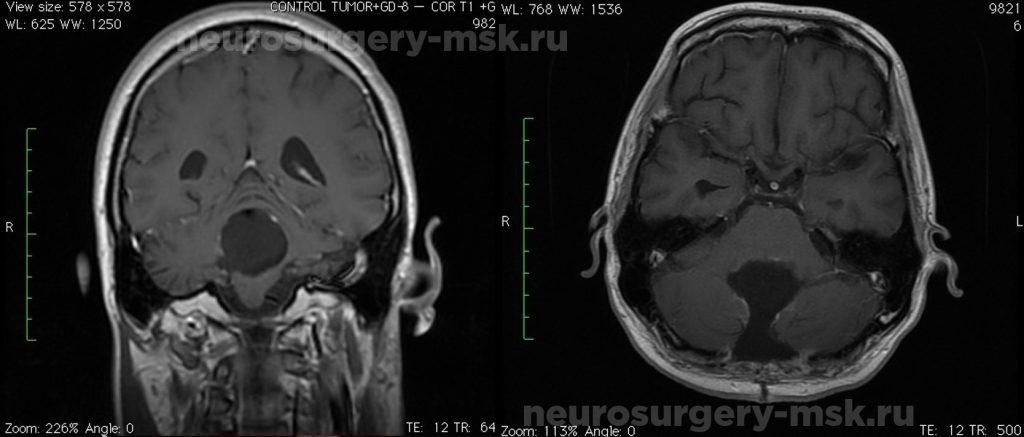 Пиллоидная астроцитома червя мозжечка и IV желудочка после операции