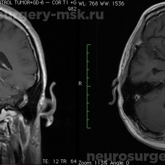 Пиллоидная астроцитома червя мозжечка и IV желудочка после операции