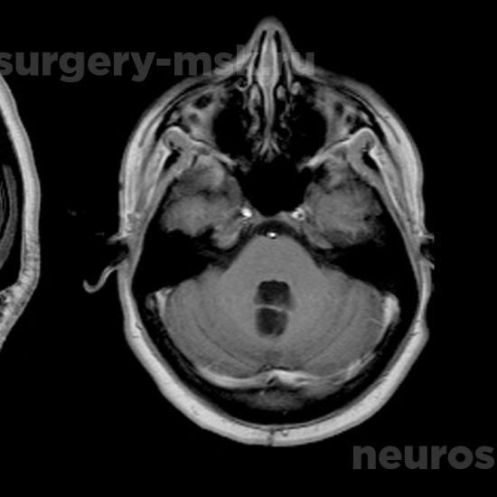 Пиллоидная астроцитома червя мозжечка и IV желудочка с большим кистозным компонентом после операции