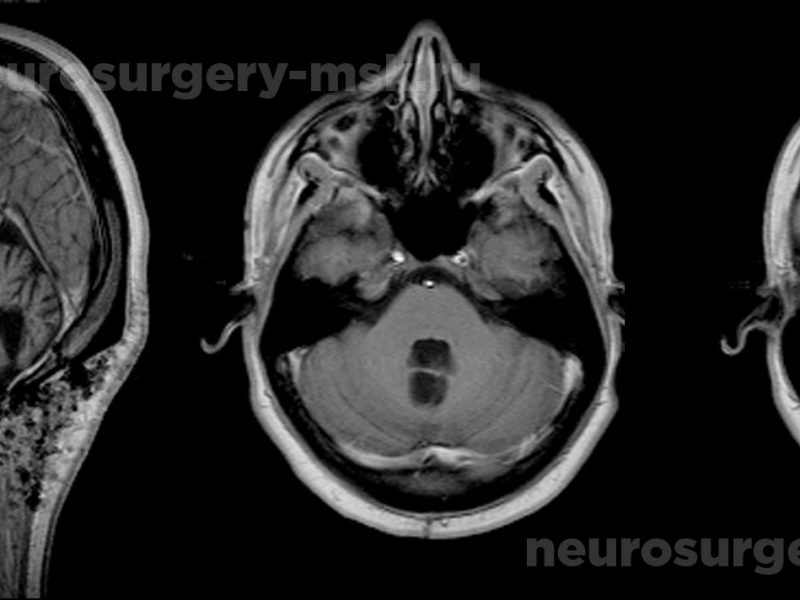 Пиллоидная астроцитома червя мозжечка и IV желудочка с большим кистозным компонентом после операции
