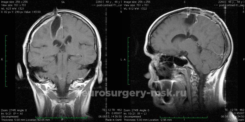 Удаление метастаза рака лёгкого в головной мозг (после операции)