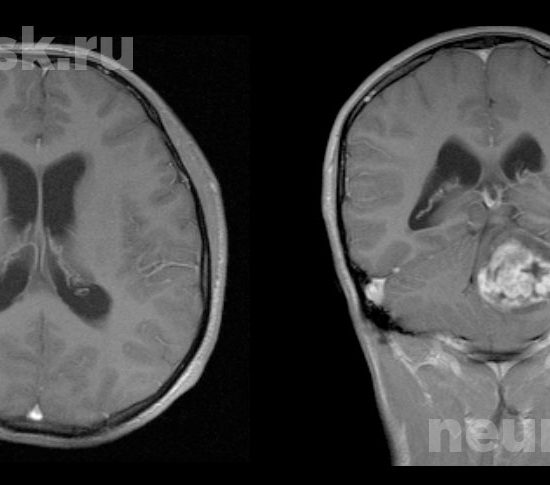 Удаление опухоли полушария мозжечка до операции