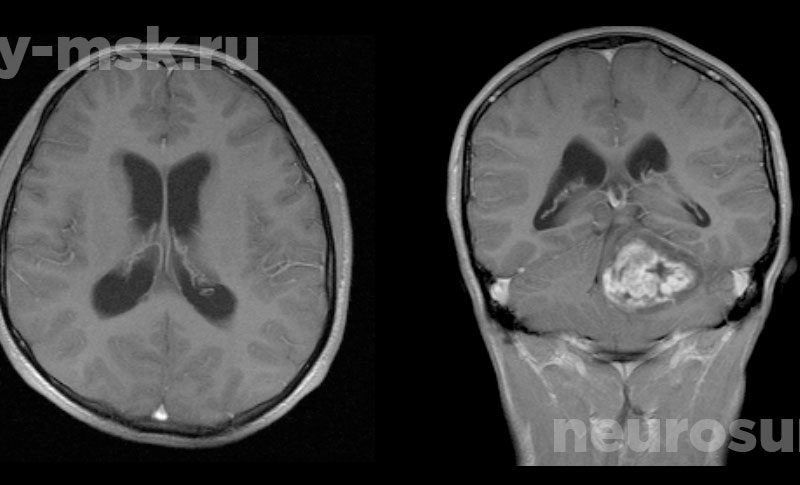 Удаление опухоли полушария мозжечка до операции