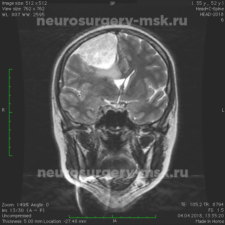 После операции менингиомы головного мозга. Менингиома пирамиды височной кости. Фалькс менингиома головного. Ольфакторная ямка менингиома.
