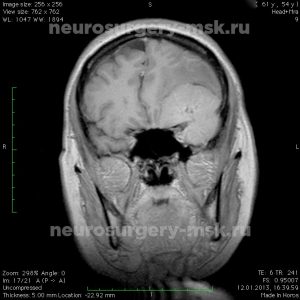 Симптомы, диагностика и лечение опухоли основания черепа