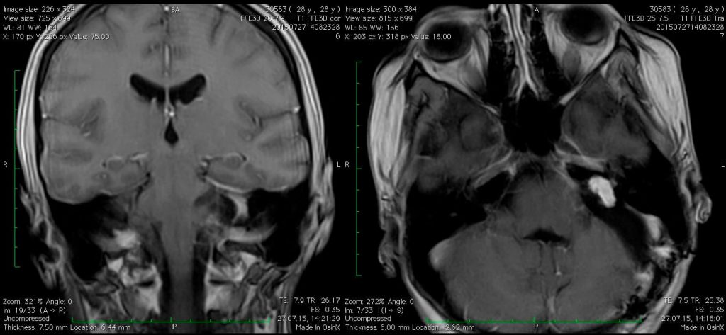 Невринома VIII нерва после операции