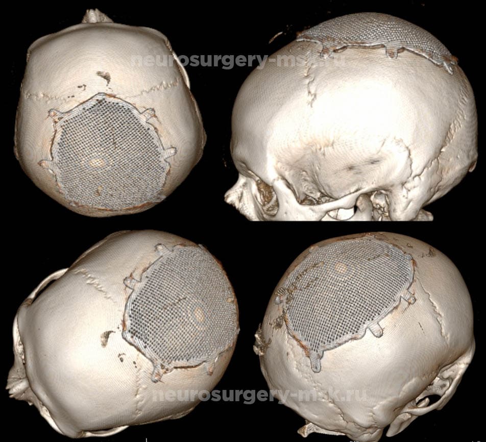 КТ головного мозга после краниопластики в режиме 3D реконструкции