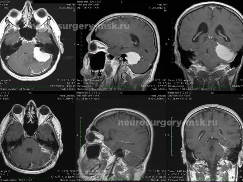 После операции менингиомы головного мозга. Менингиома лобной кости кт. Менингиома лобной доли кт. Менингиома головного мозга кт.