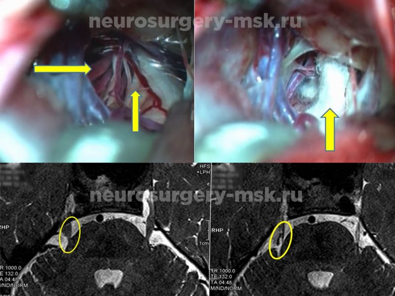 Невралгия тройничного нерва справа (1)