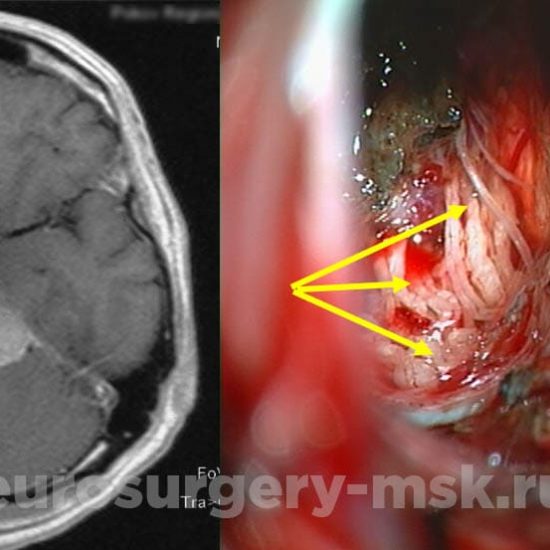 Петрокливальная менингиома слева с невралгией тройничного нерва