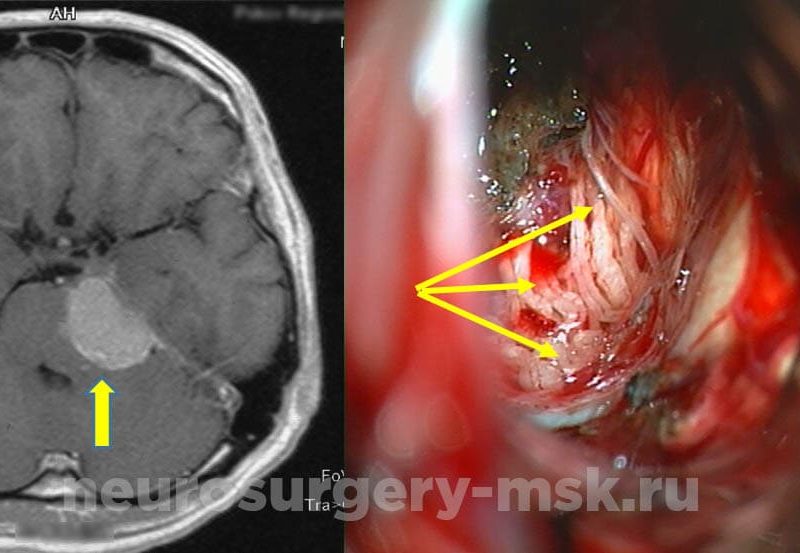 Петрокливальная менингиома слева с невралгией тройничного нерва