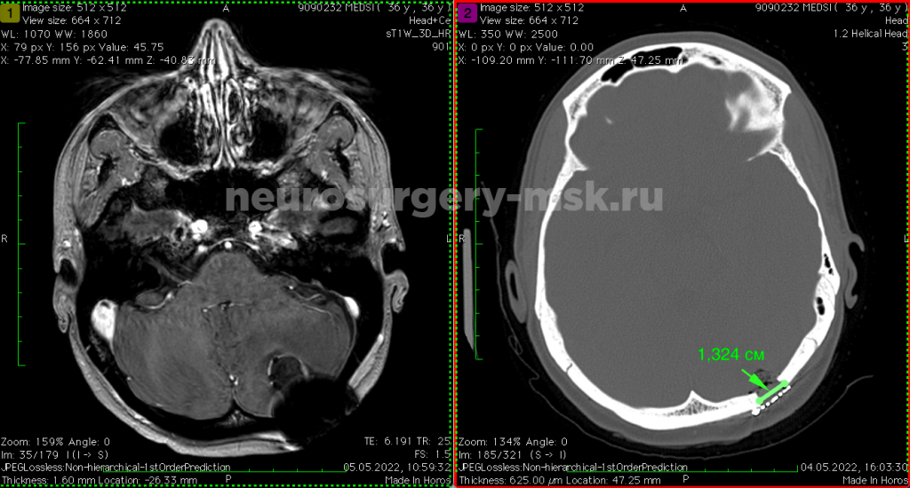 МРТ и КТ после операции. Размер костного окна доступа 1,324 см
